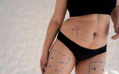 ¿QUÉ ES EL LIPOFILLING Y CÓMO SABER SI ES PARA TI?