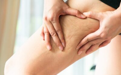 CELULITIS: CAUSAS Y CÓMO TRATARLA