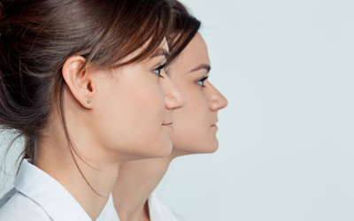 Rinoplastia vs. Rinomodelación: Diferencias