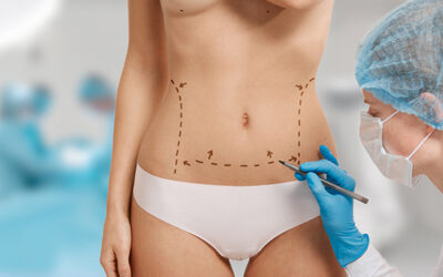 LIPOSUCCIÓN VS. ABDOMINOPLASTIA: ¿CUÁL ES LA DIFERENCIA Y CUÁNDO UTILIZAR CADA UNA?