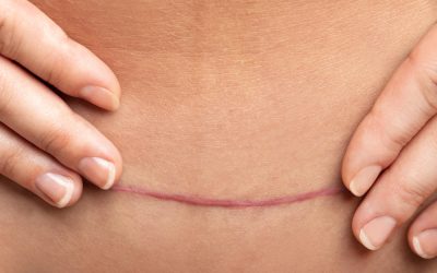 Cicatrices en cirugía plástica: lo que nadie te cuenta
